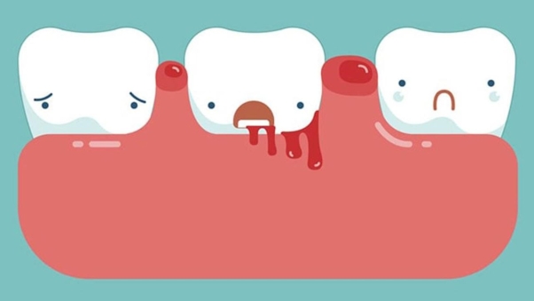 Giấc mơ chảy máu liên quan tới rụng răng có ý nghĩa gì?